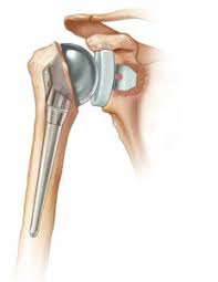 Shoulder Replacement $6000